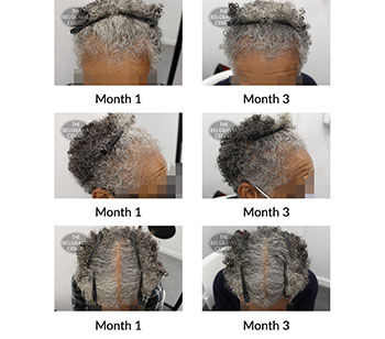 alert female pattern hair loss the belgravia centre 426713 03 11 2021