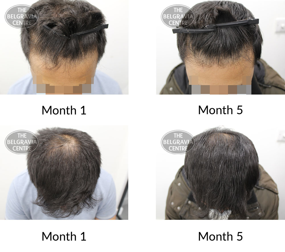 male pattern hair loss the belgravia centre 425757 271121