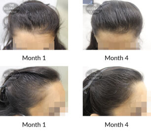 female pattern hair loss the belgravia centre 404904 30 10 2020