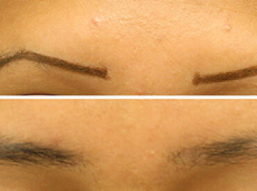 Yale Doctors Used Topical Ruxolitinib Cream to Regrow Hair and Eyebrows on Patient