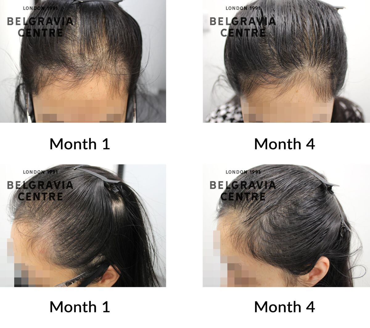 female pattern hair loss the belgravia centre 432983