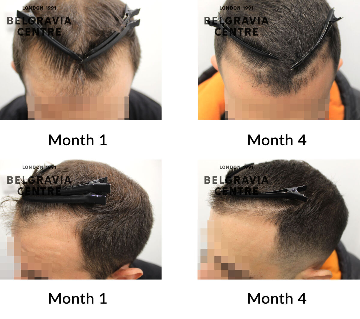 male pattern hair loss the belgravia centre 445835