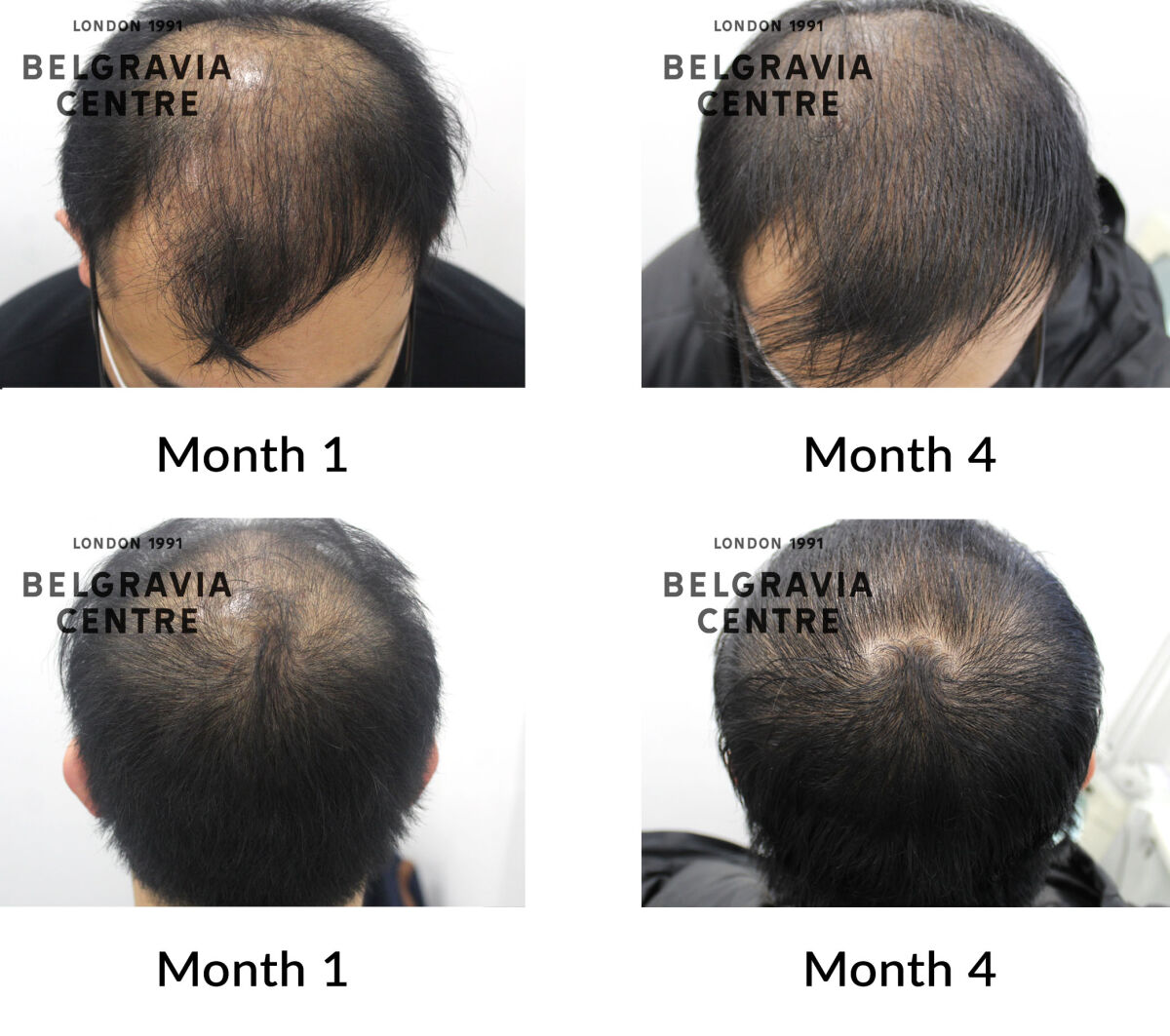 male pattern hair loss the belgravia centre 434115