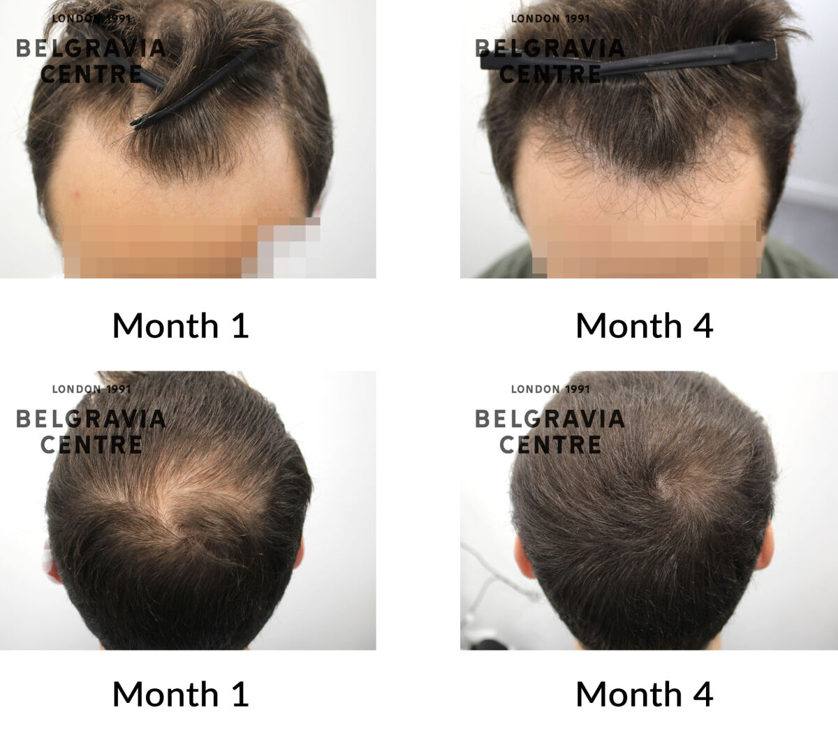 male pattern hair loss the belgravia centre 441075