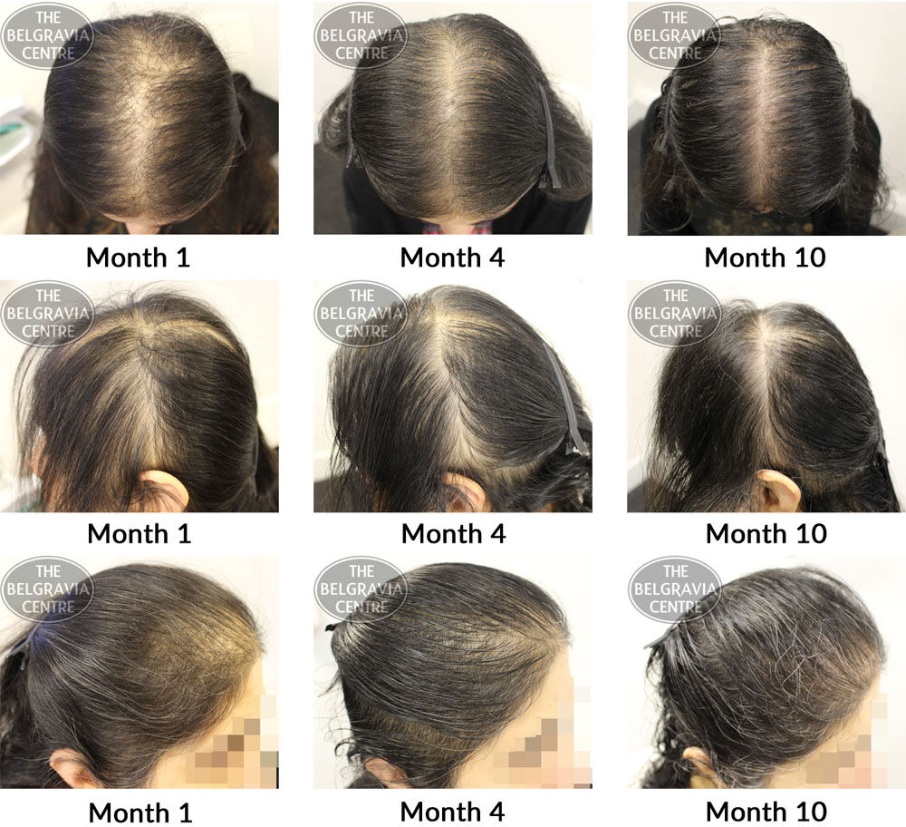 female pattern hair loss chronic telogen effluvium the belgravia centre zk 29 11 2018