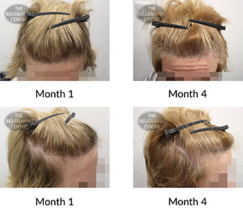 alert female pattern hair loss the belgravia centre 423158 03 09 2021
