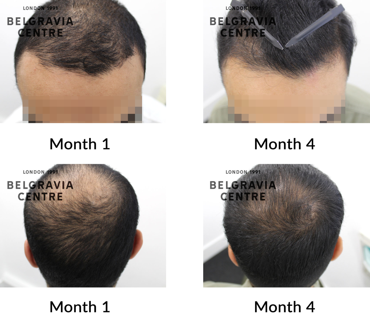 male pattern hair loss the belgravia centre 435261