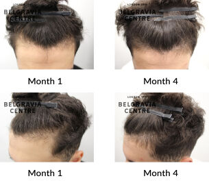 male pattern hair loss the belgravia centre 437410