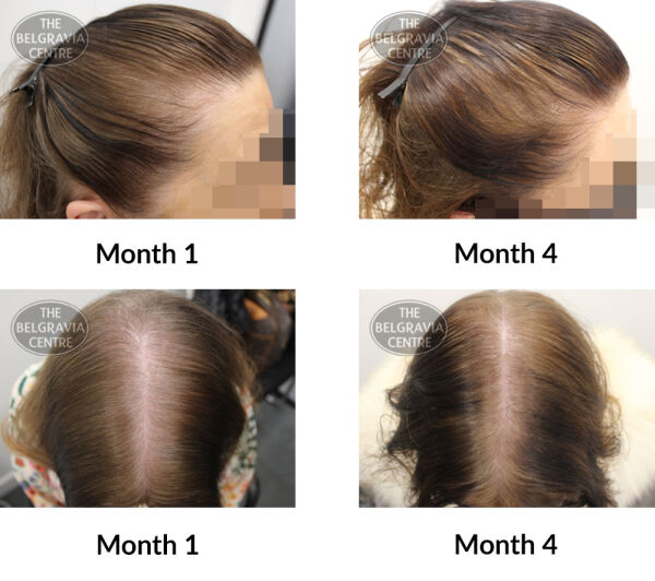 female pattern hair loss and diffuse thinning the belgravia centre 397431 15 07 2020
