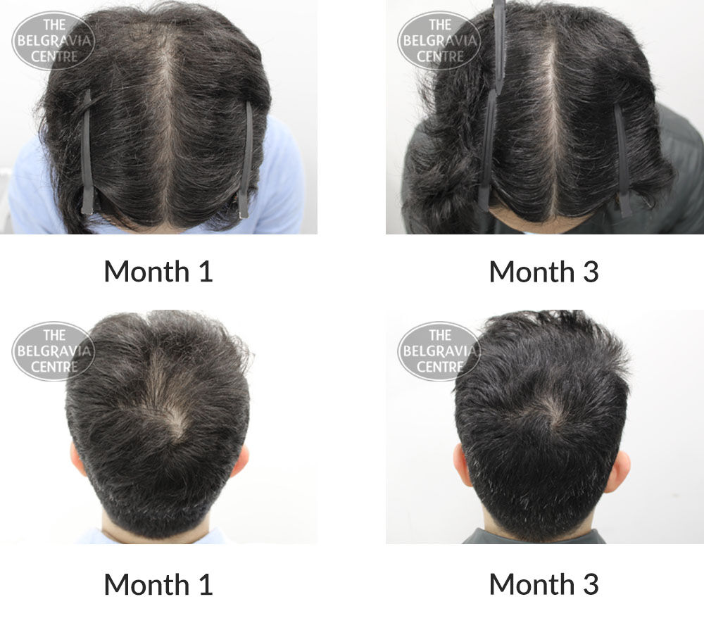 male pattern hair loss the belgravia centre 404285 21 10 2020