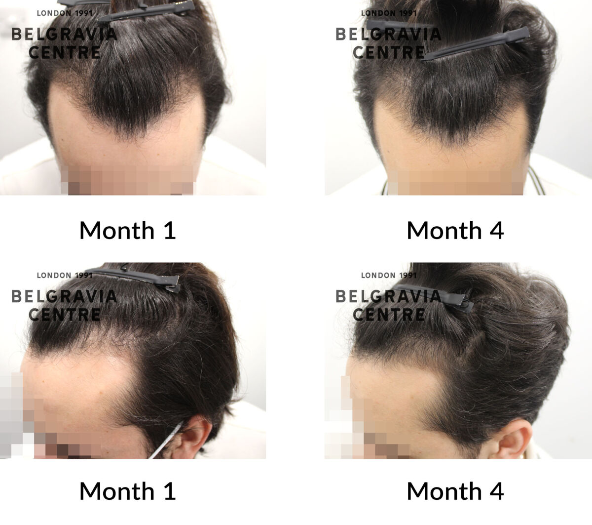 male pattern hair loss the belgravia centre 437186