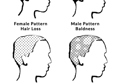 diagram locations areas of scalp affected by stress related hair loss conditions