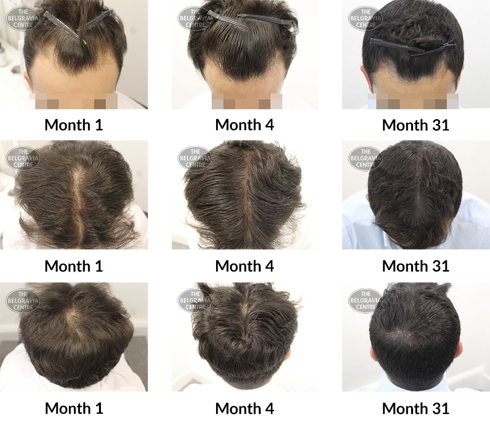 male pattern hair loss the belgravia centre 330701 14 02 2020