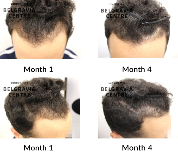 male pattern hair loss the belgravia centre 453985