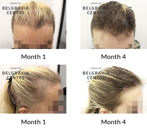 female pattern hair loss and telogen effluvium the belgravia centre 430221 1