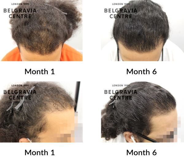 male pattern hair loss the belgravia centre 428586