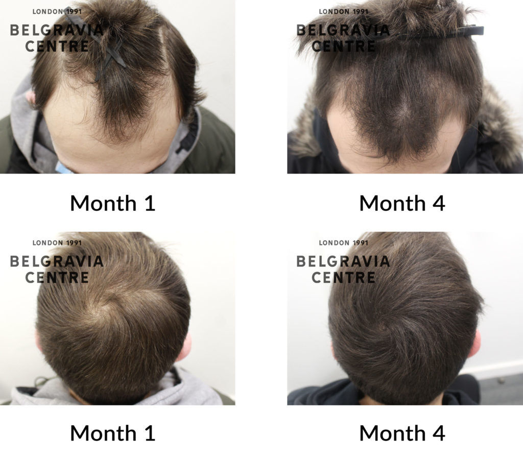 male pattern hair loss the belgravia centre 430101 1024x907