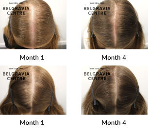 female pattern hair loss and telogen effluvium the belgravia centre 447633