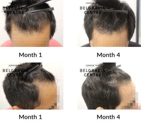 male pattern hair loss the belgravia centre 446006