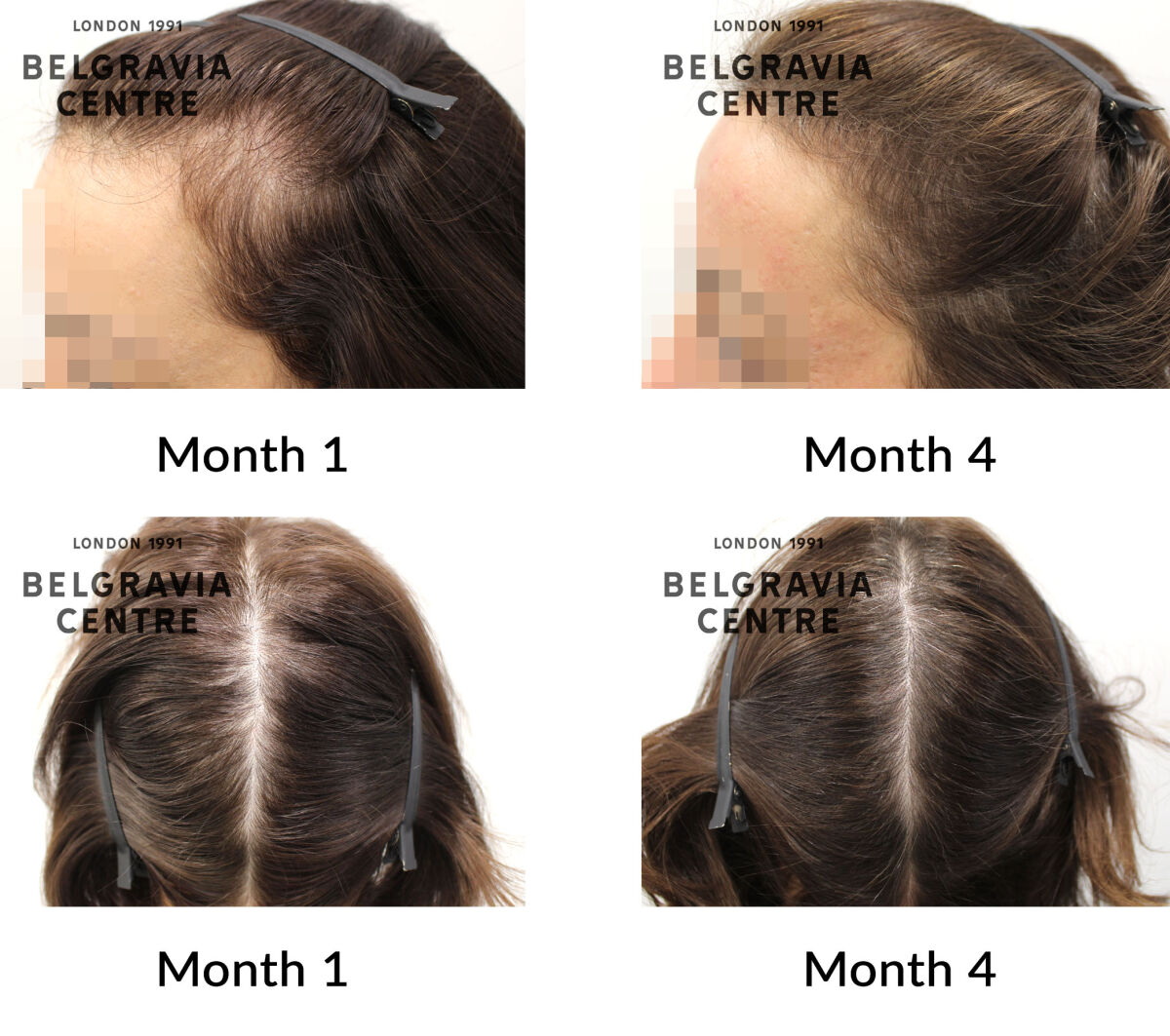 female pattern hair loss and diffuse thinning the belgravia centre 331267
