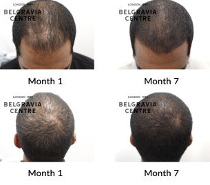 male pattern hair loss the belgravia centre 432222