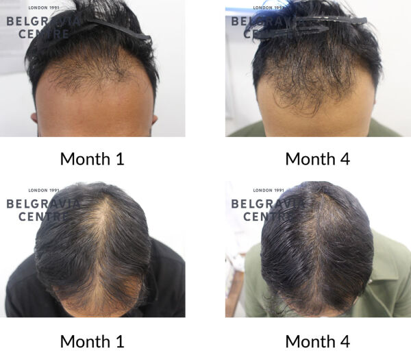 male pattern hair loss the belgravia centre 425597 191121