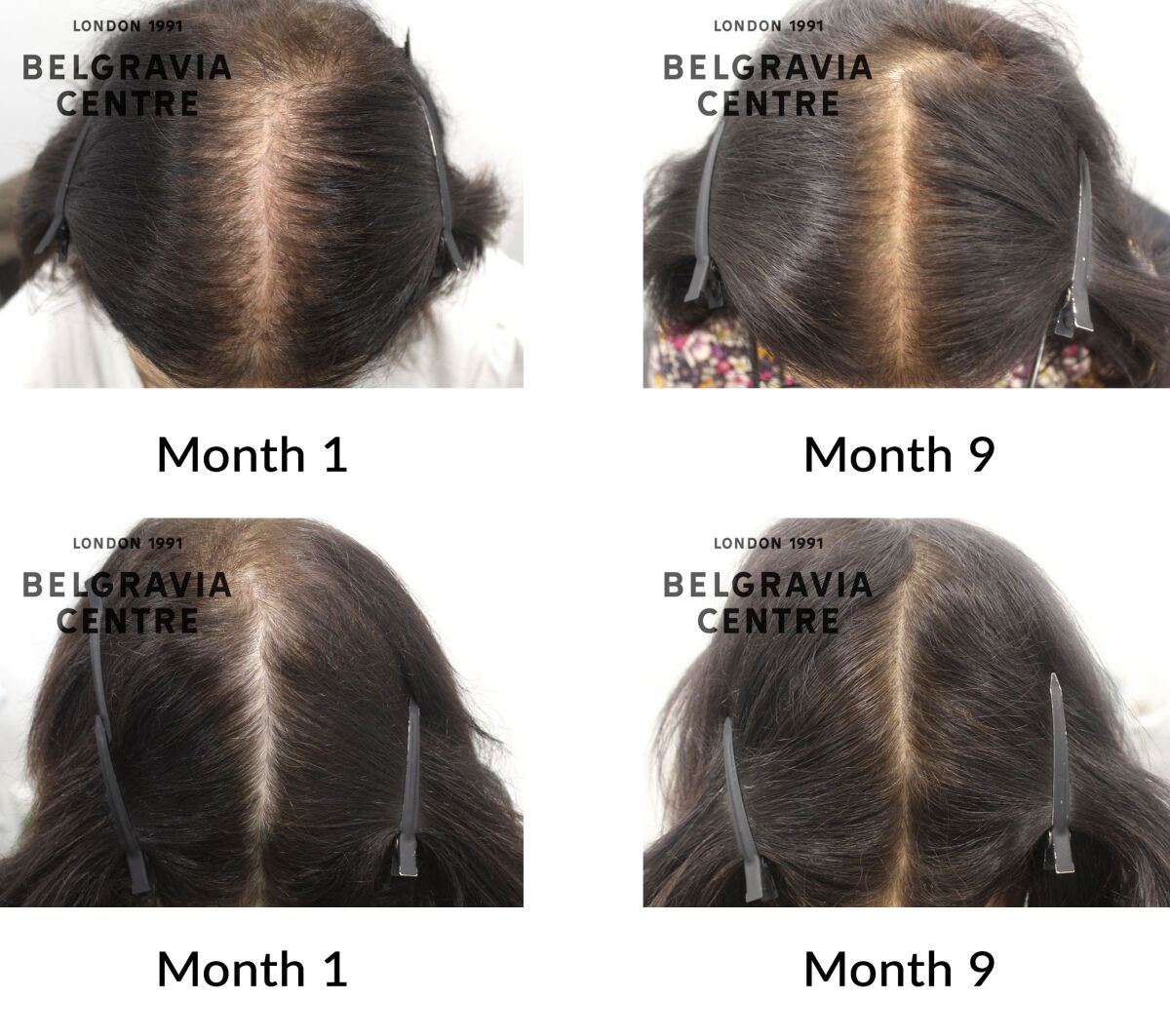 female pattern hair loss the belgravia centre 429215