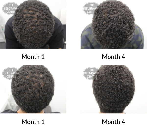 male pattern hair loss the belgravia centre 393968 25 08 2020