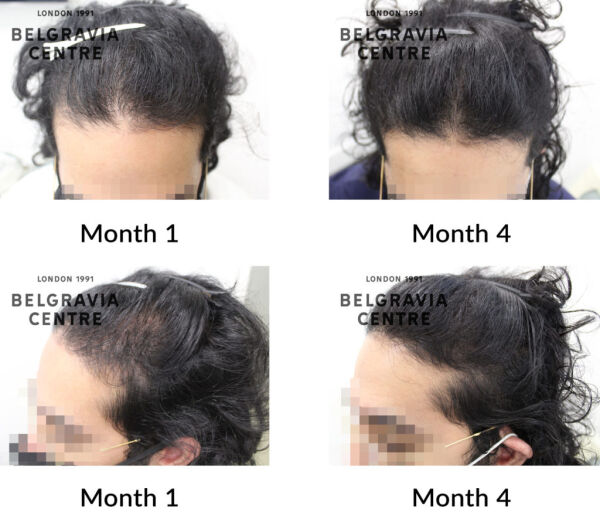 male pattern hair loss the belgravia centre 429872 1024x907