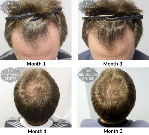 male pattern hair loss the belgravia centre cf 30 01 17