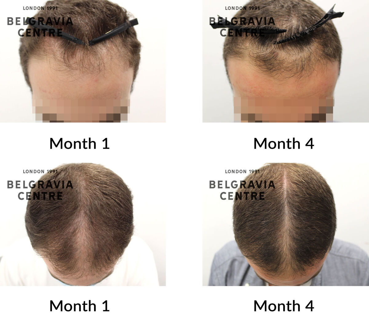 male pattern hair loss the belgravia centre 436778