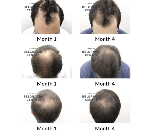 male pattern hair loss the belgravia centre 430544