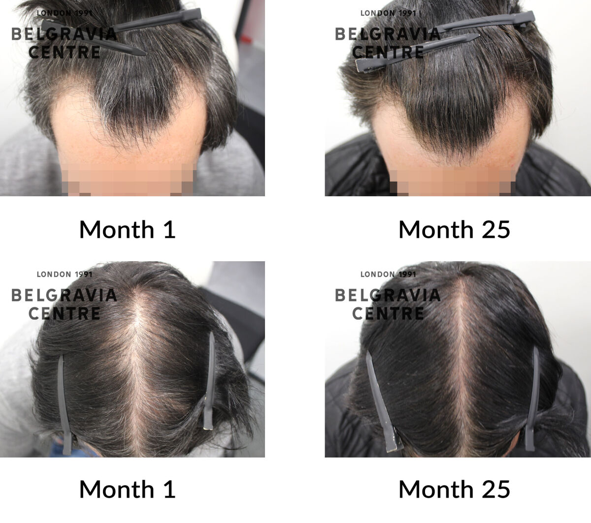 male pattern hair loss the belgravia centre 397235