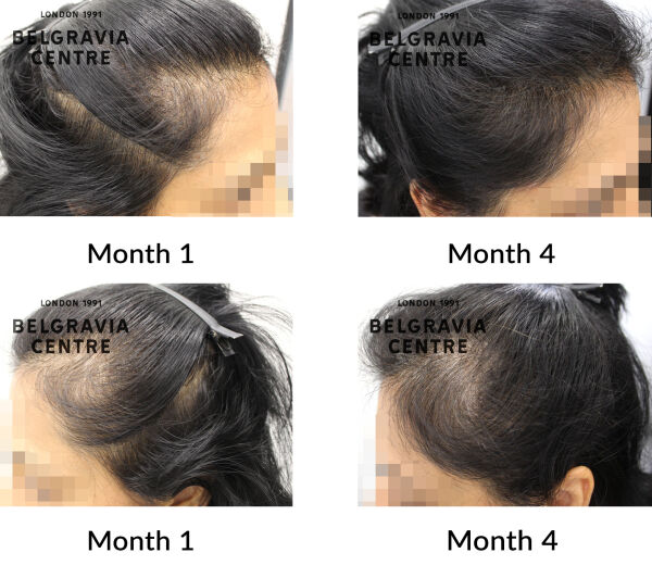 female pattern hair loss the belgravia centre 452716
