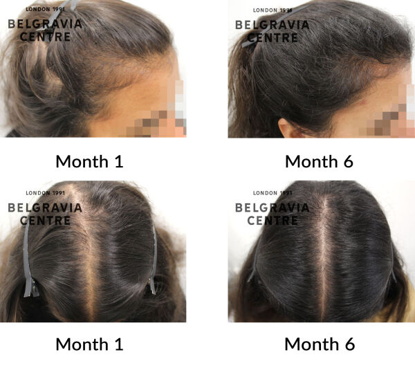 female pattern hair loss and diffuse thinning the belgravia centre 446752