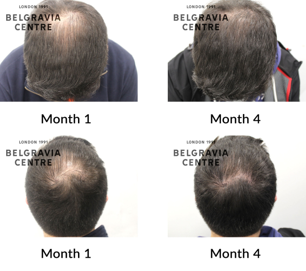 male pattern hair loss the belgravia centre 433669