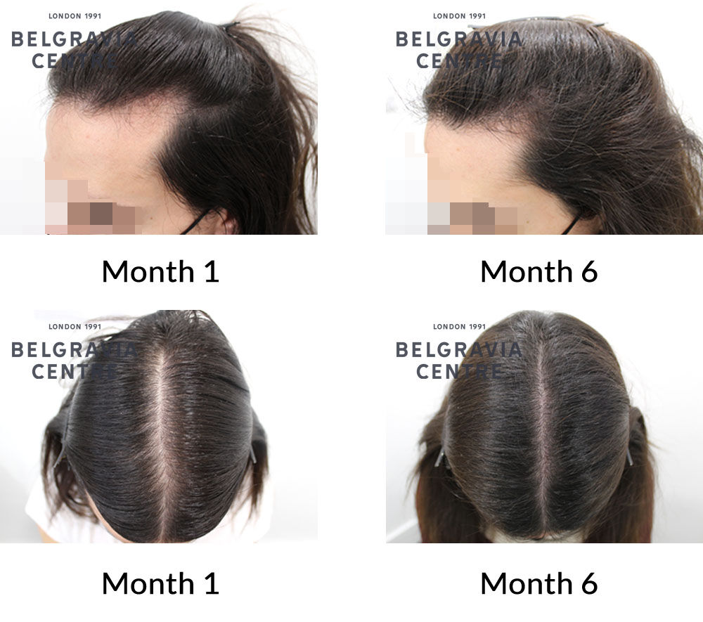 male pattern hair loss the belgravia centre 424738 081221