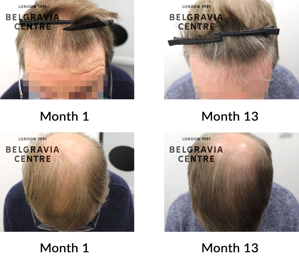 male pattern hair loss the belgravia centre 422769