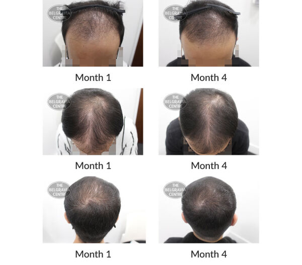 male pattern hair loss the belgravia centre 387163 21 10 2020