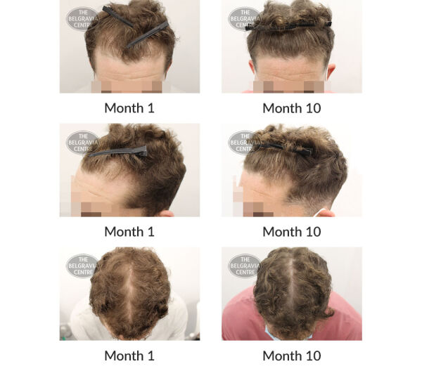 male pattern hair loss the belgravia centre 394872 13 10 2020