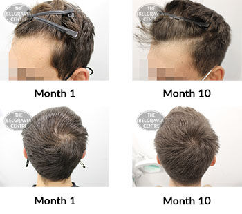 alert male pattern hair loss the belgravia centre 413327 13 09 2021