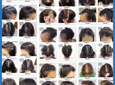 Womens Hair Loss Success Stories Large Photo