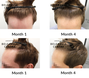 male pattern hair loss the belgravia centre 458104