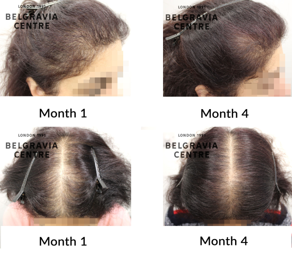 female pattern hair loss the belgravia centre 450894
