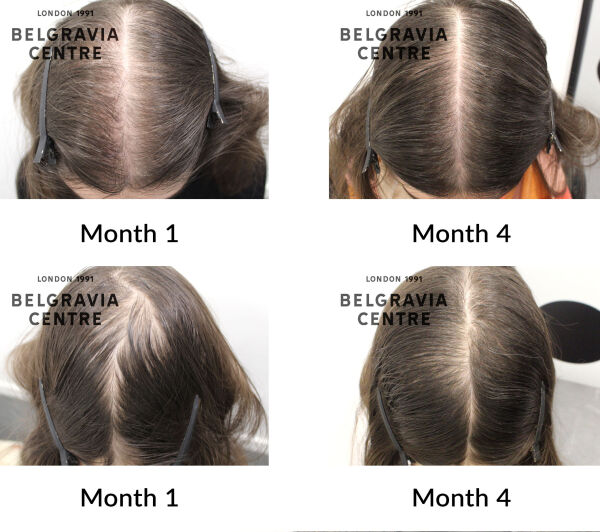 female pattern hair loss the belgravia centre 433506