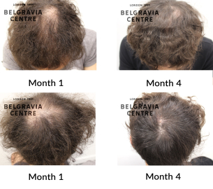 male pattern hair loss the belgravia centre 458208