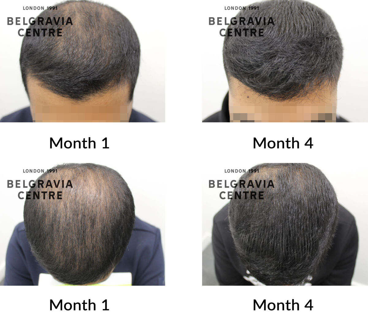 male pattern hair loss the belgravia centre 443261