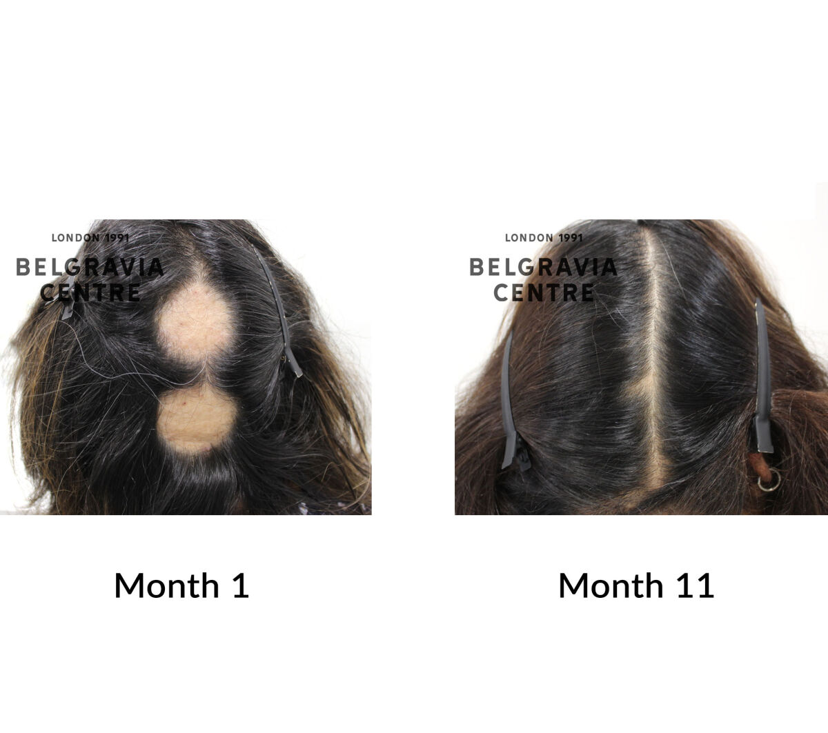 alopecia areata the belgravia centre 426785