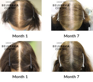 telogen effluvium and female pattern hair loss the belgravia centre 427061
