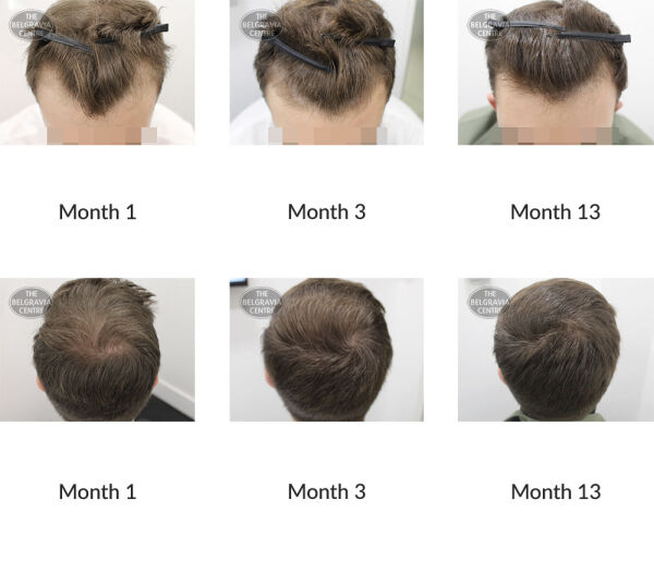 male pattern hair loss the belgravia centre 390672 09 10 2020